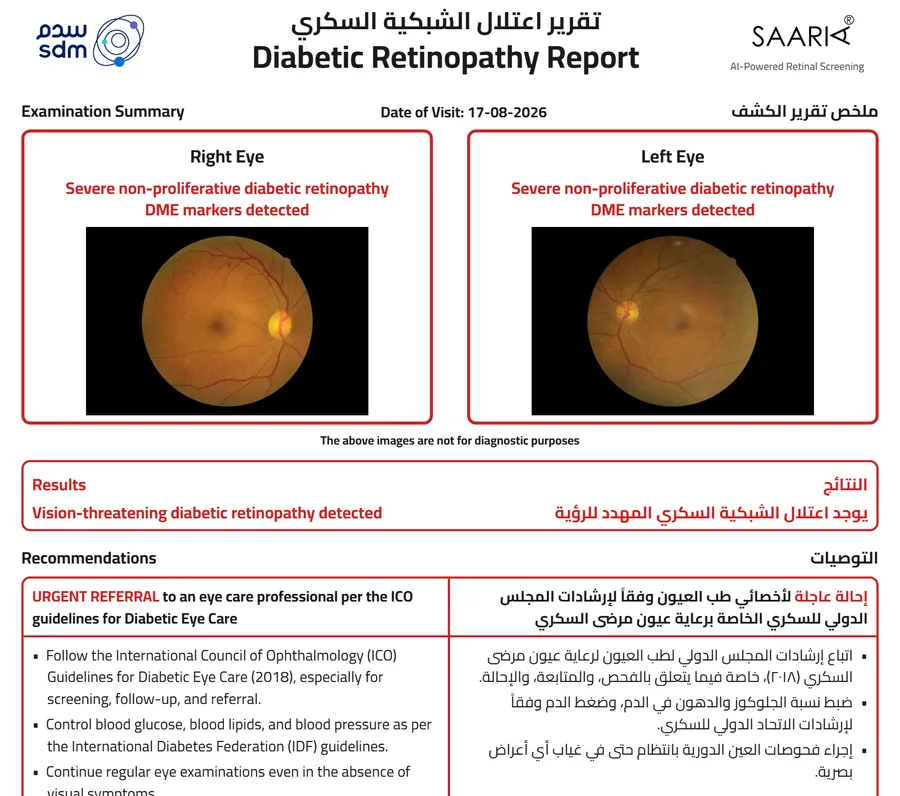 Sample SAARIA report: severe non-proliferative diabetic retinopathy with macular edema markers in both eyes, recommending urgent referral.